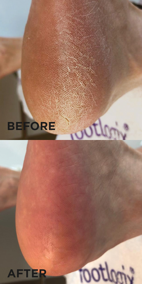 Footlogix® CALLUS SOFTENER Professional Beauty