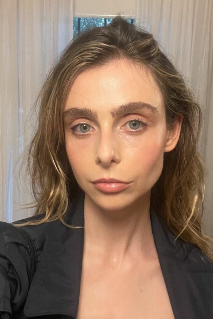 Ruby Feneley post microneedling treatment
